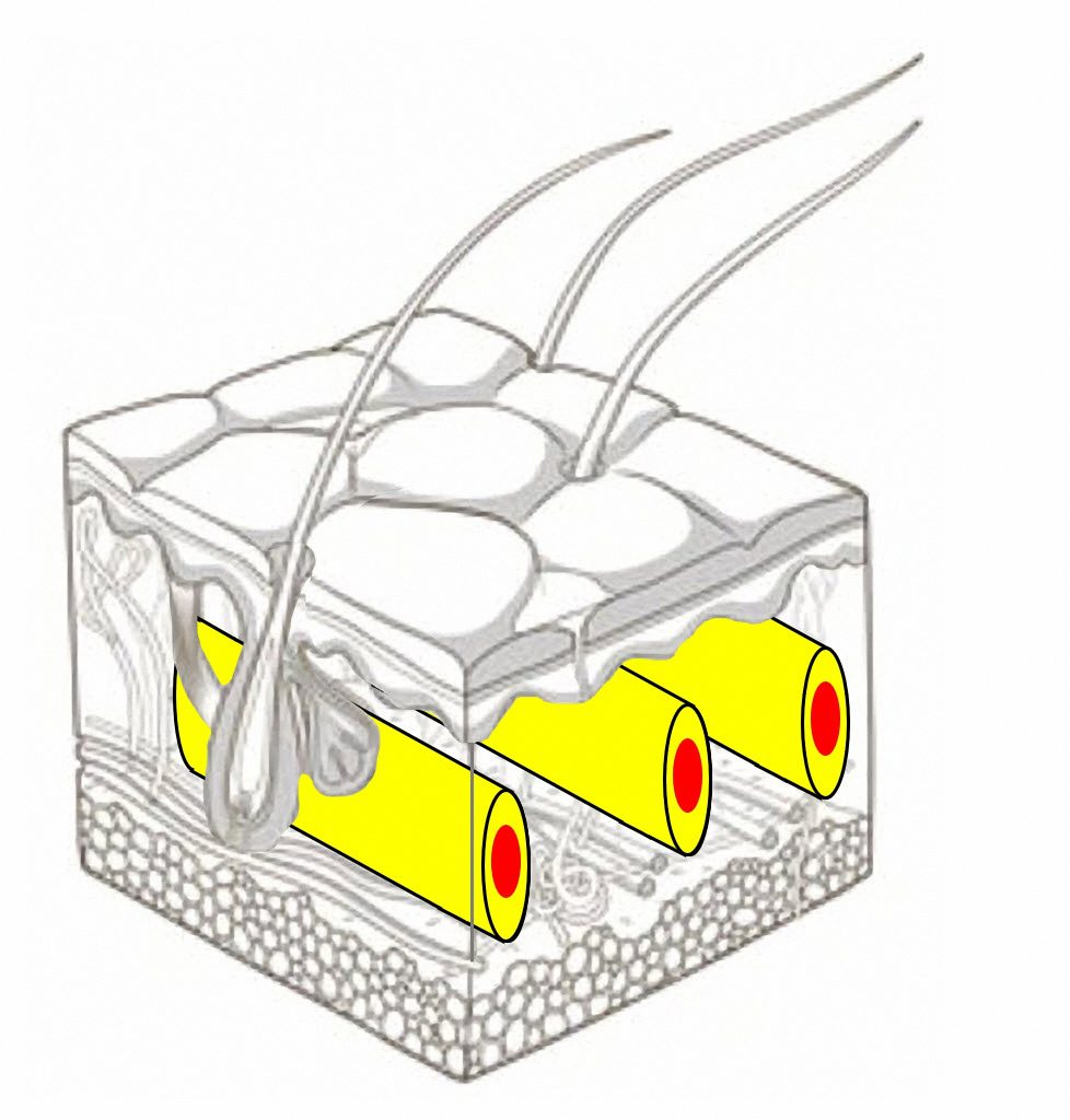 sofwave particolare